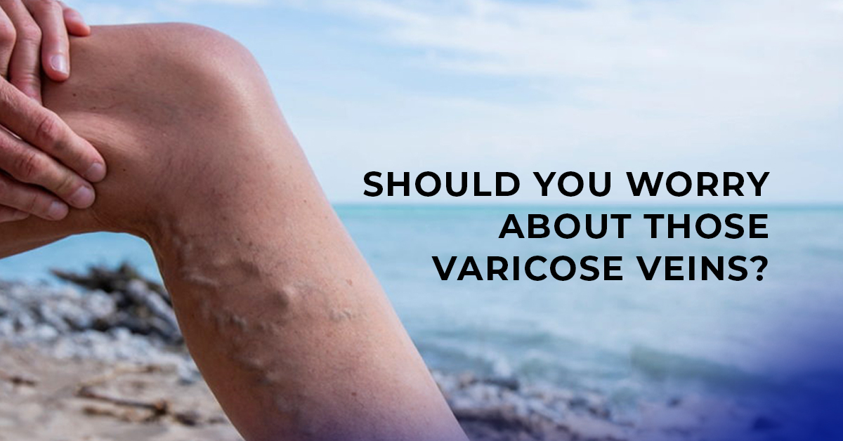 Should You Worry About Those Varicose Veins