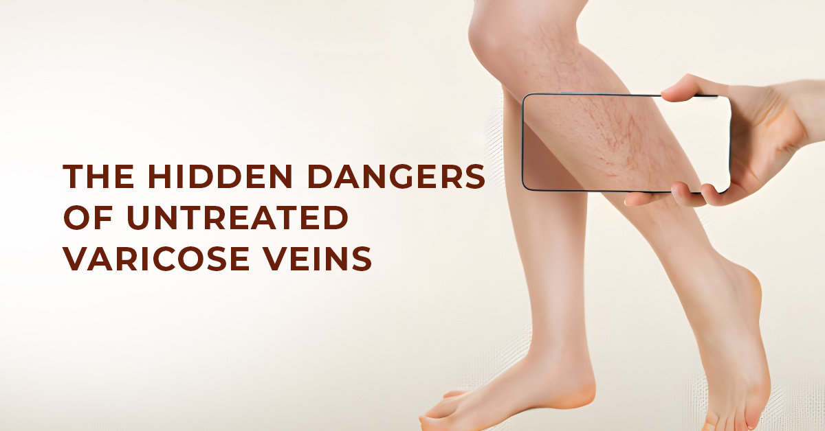 The Hidden Dangers of Untreated Varicose Veins