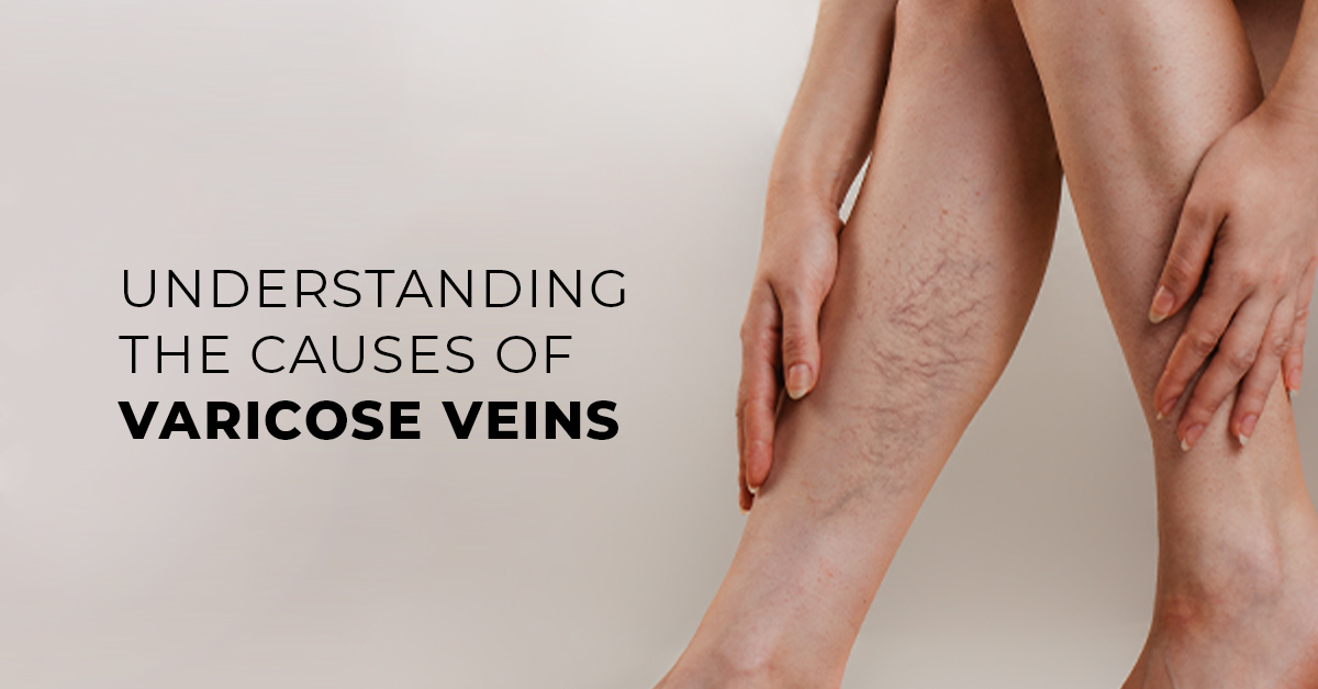 Varicose Veins: Causes, Symptoms, and Treatment