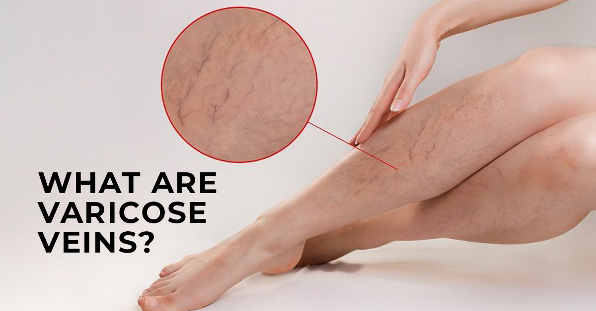 What are Varicose Veins